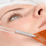Baixar Grátis – Peeling Quimico